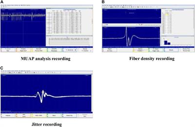 Motor Unit Properties of the First Dorsal Interosseous in Chronic Stroke Subjects: Concentric Needle and Single Fiber EMG Analysis